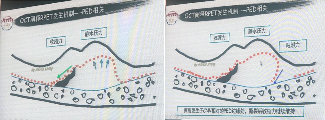 wamd抗vegf治疗中rpe撕裂的危险因素及预后分析