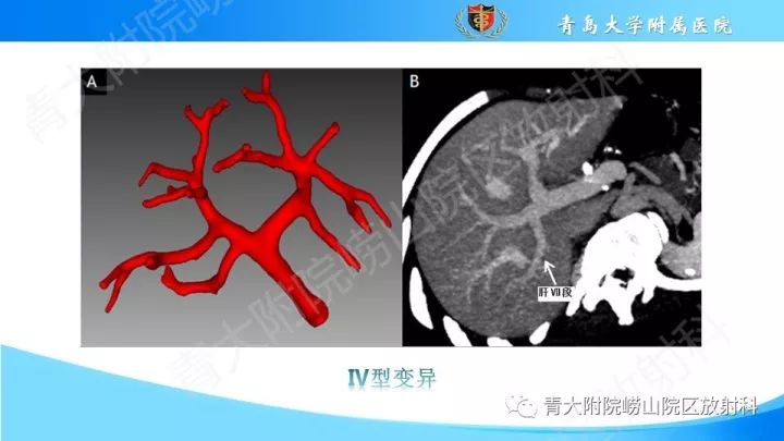 门静脉解剖,变异及常见病变影像表现