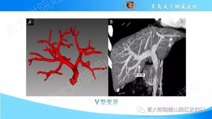 门静脉解剖,变异及常见病变影像表现