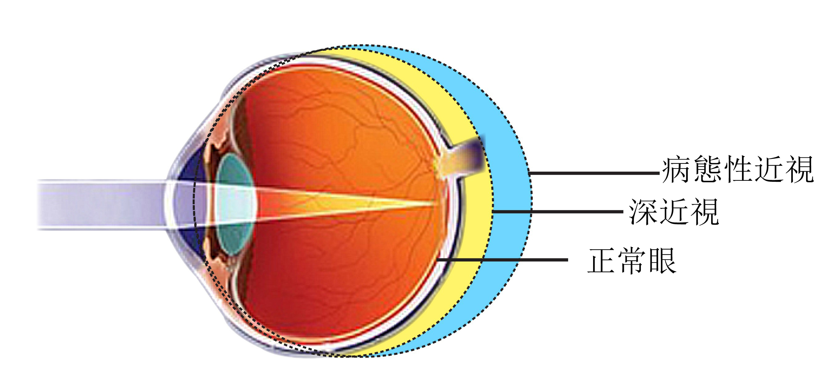 患者,因为会导致晶体密度增加,使得整个眼球的屈光力增强; 曲率性近视