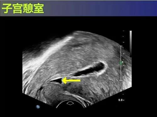 别不在意，子宫上的这个“小洞洞”可是不定时炸弹！