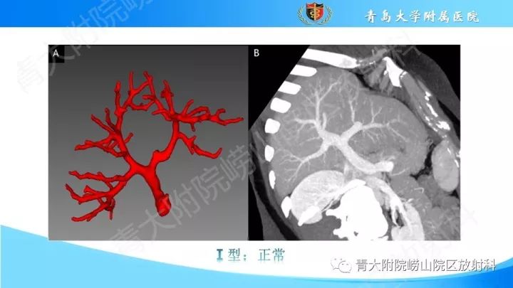 门静脉解剖,变异及常见病变影像表现