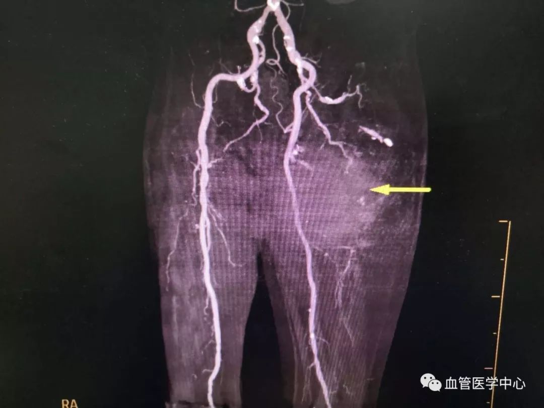 关注血管疾病-我科收治假性动脉瘤患者