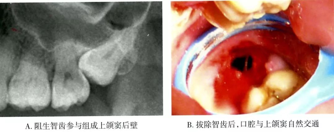 拔牙术中上颌窦如发生小的穿孔(直径2 mm左右),可按拔牙后常规处理待