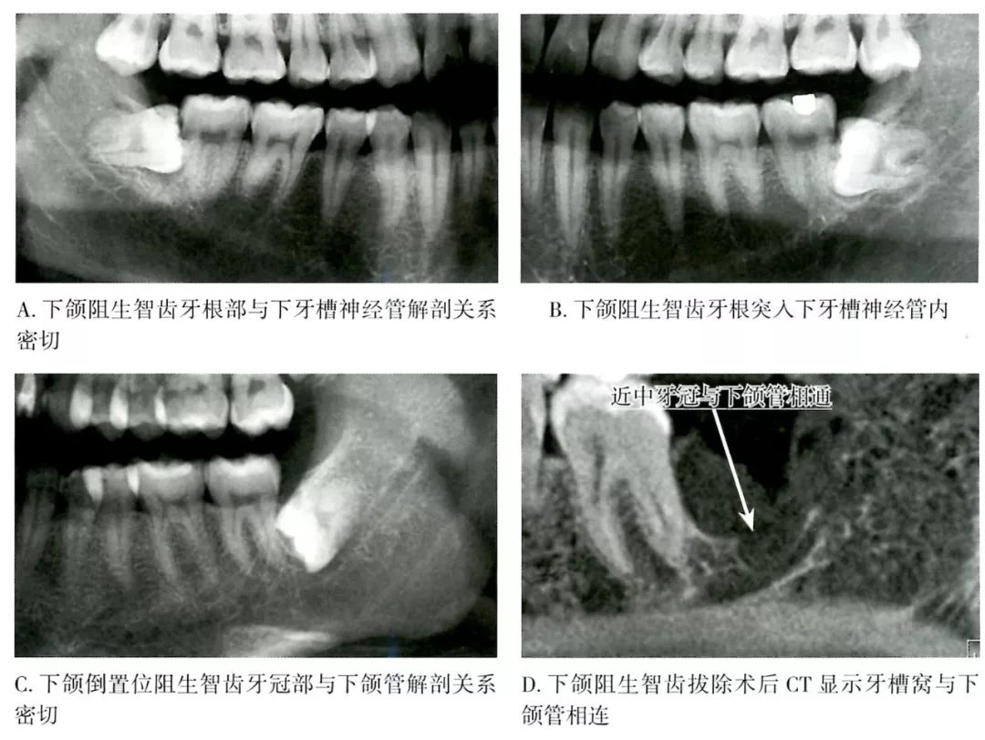 了解牙根与下颌管的关系