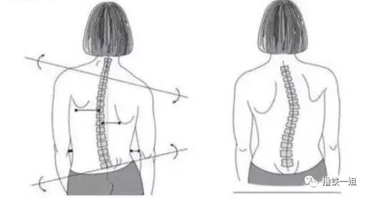 骨盆前倾,肋骨外翻,肩胛骨突出程度