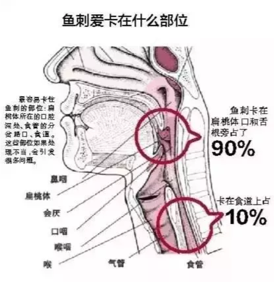 食道卡鱼刺怎么办