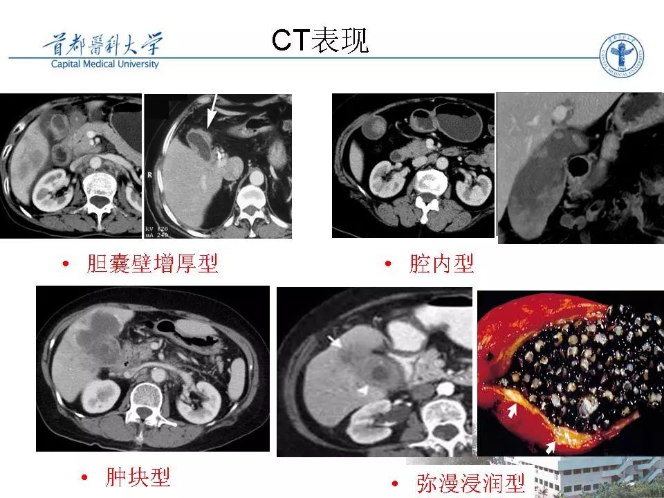 胆囊癌ct诊断 | 影像天地