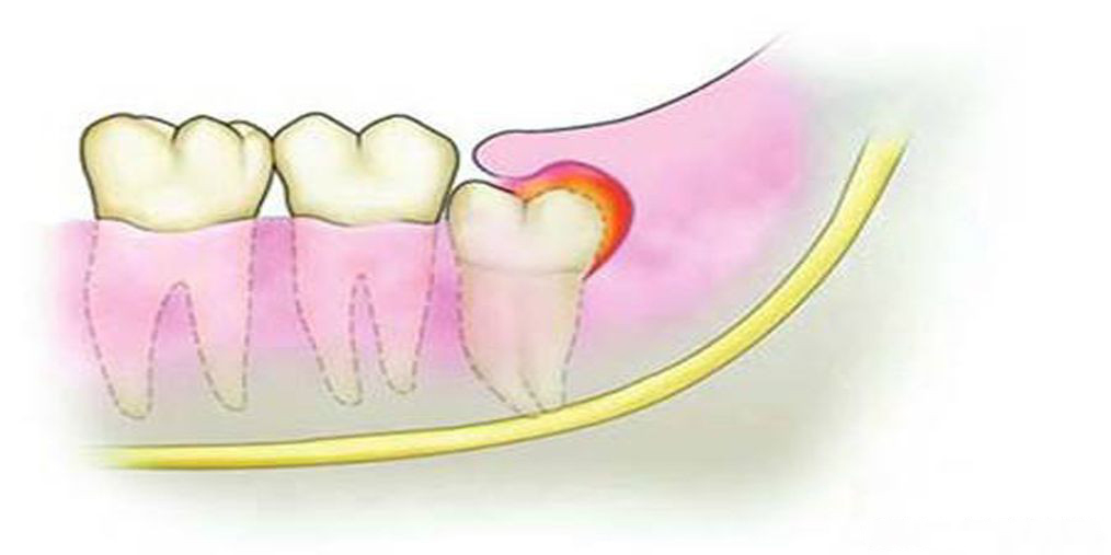 深圳口腔医院你知道吗丨阻生智齿的危害!