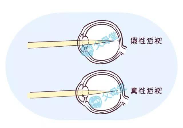 原创孩子真假近视傻傻分不清楚把握关键期假性近视依旧可逆