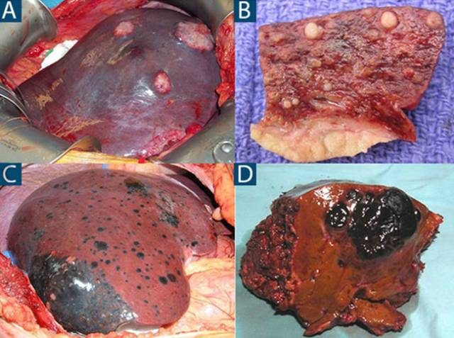 ahmad「上图a和图c是肝转移癌术中照片,原发肿瘤分别为直肠胃肠间质