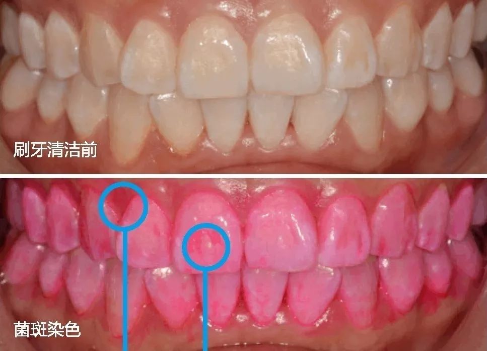 原创科普用菌斑染色来了解自己的口腔卫生状况