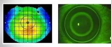 塑形镜的原理_△角膜塑形镜视力矫正原理