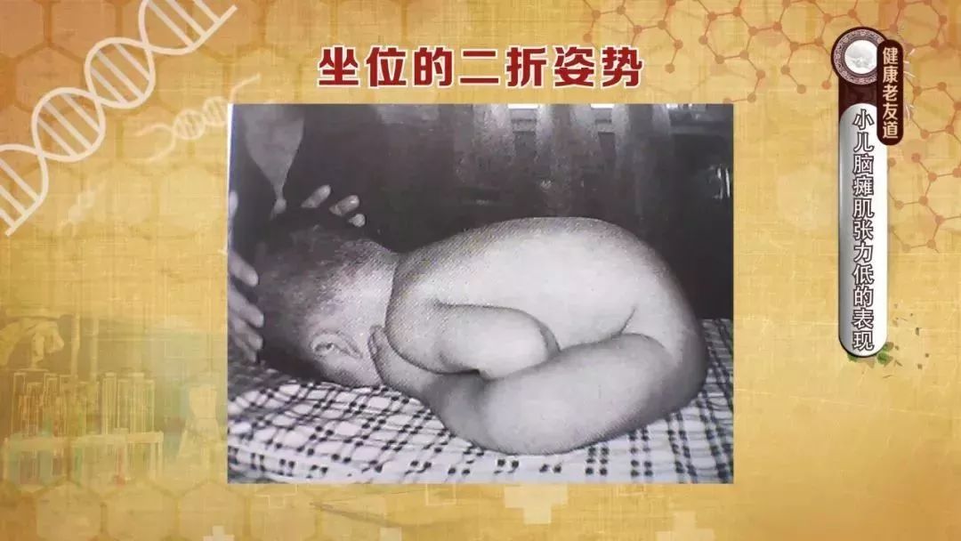 孩子出现这7种姿势要警惕脑瘫! 尤其是早产儿_患儿