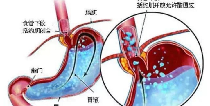 烧心是什么原理_烧心吃什么药(2)