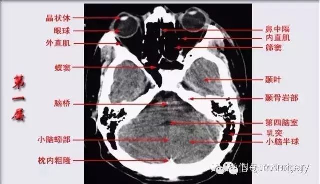 【推荐】详解头颅ct的断层解剖