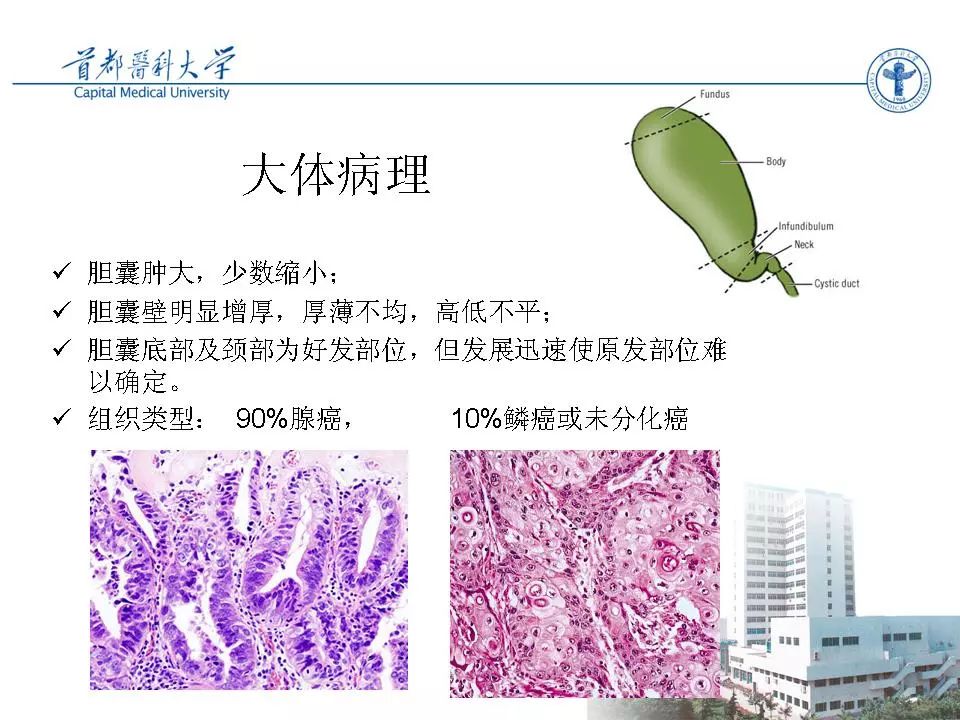 胆囊癌ct诊断 | 影像天地