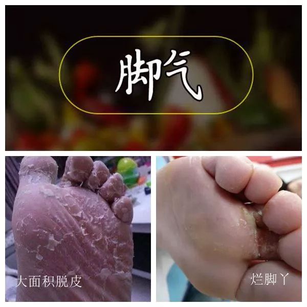 细菌病毒更容易"趁虚而入"更易患脚气