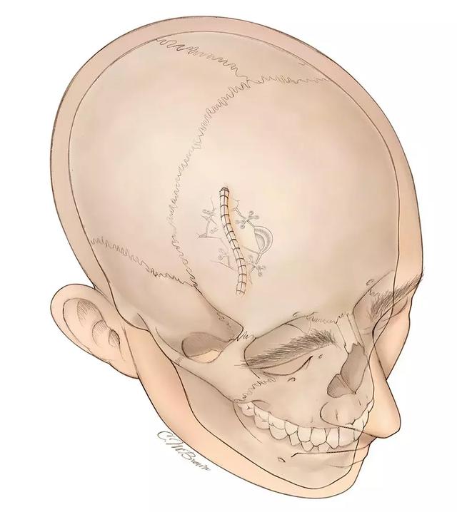 开放性颅骨骨折的手术策略与技巧