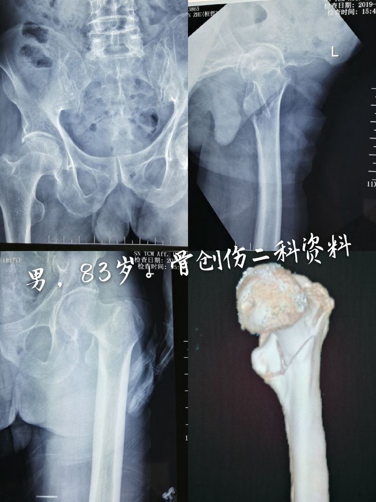 老年粗隆骨折我更愿选择对患者创伤小的内固定