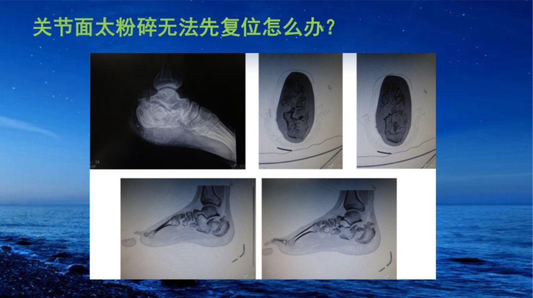 跟骨骨折如何治疗?看完这篇你就会啦