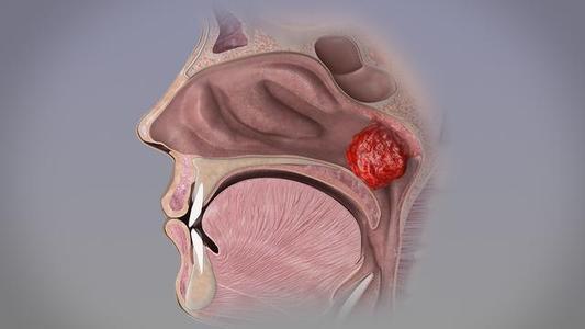 腺样体肥大