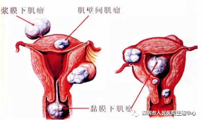 胚胎着床又失败——您的土壤好吗?