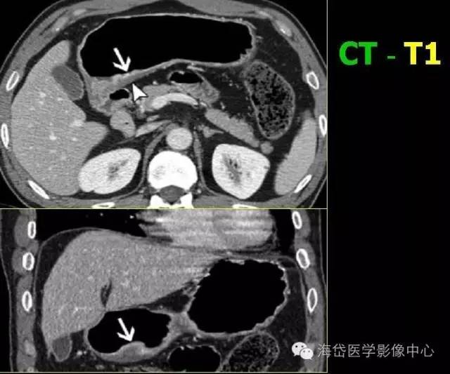 速查胃癌ct的分期