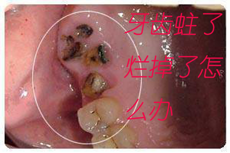 牙掉碴了怎么办