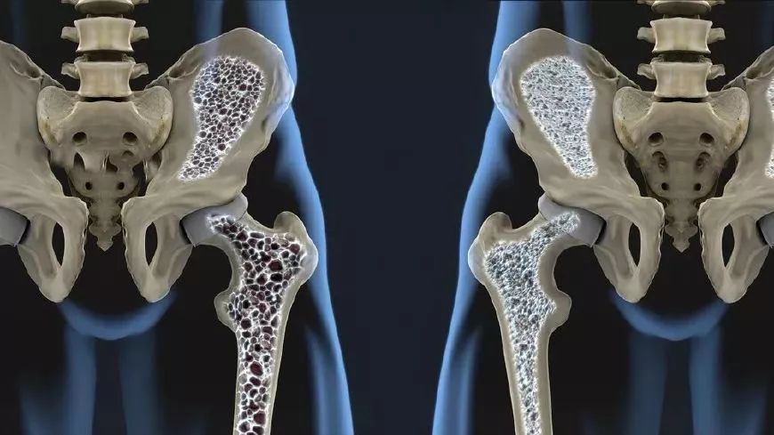 老年髋部骨折可以是在轻微外伤后造成,多半由 骨质疏松所致.