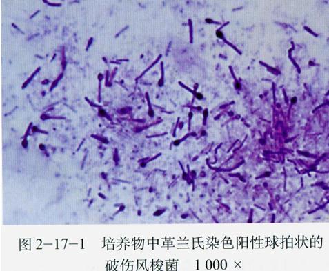 有伤口必须注射破伤风抗毒素?并不是这样的,看医生怎么说