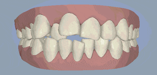 正常情况下,牙齿有一定可动度,以便缓冲咀嚼压力,防止牙齿,牙周发生