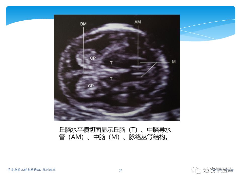 【超声微课堂】早孕期胎儿解剖结构超声检查及相关问题:头臀长,头部