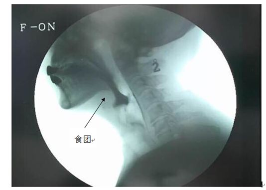 新技术为吞咽障碍患者带来福音吞咽造影检查