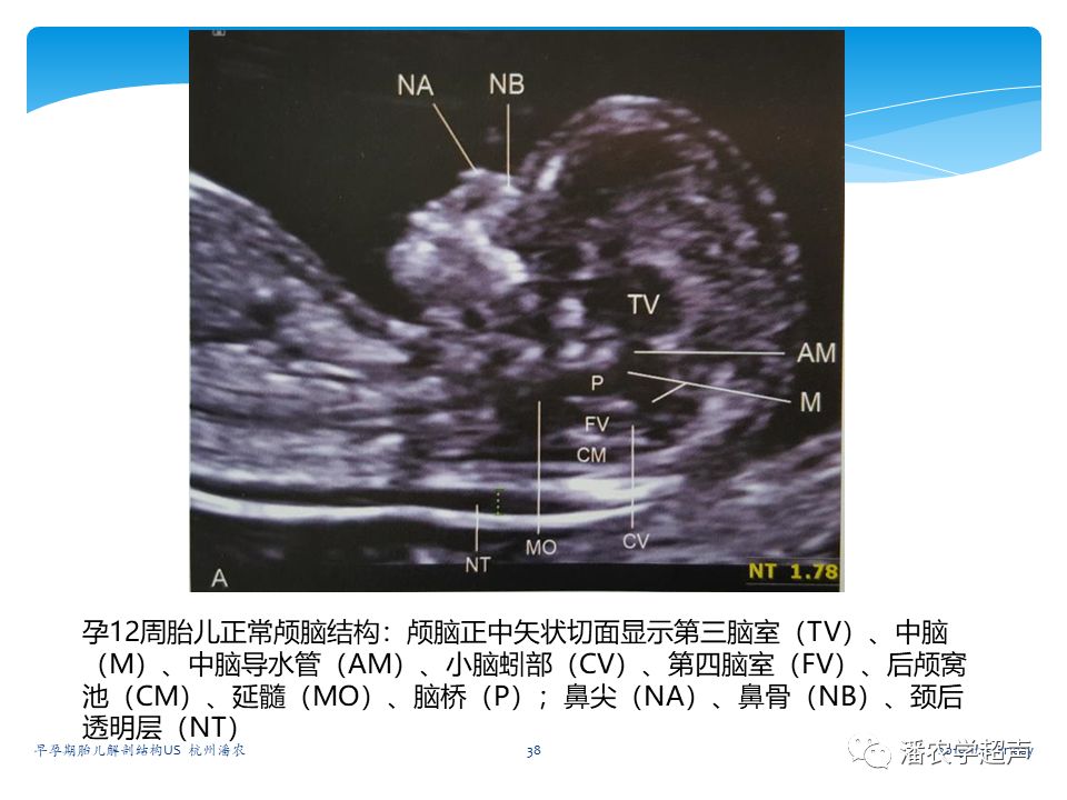 【超声微课堂】早孕期胎儿解剖结构超声检查及相关问题:头臀长,头部