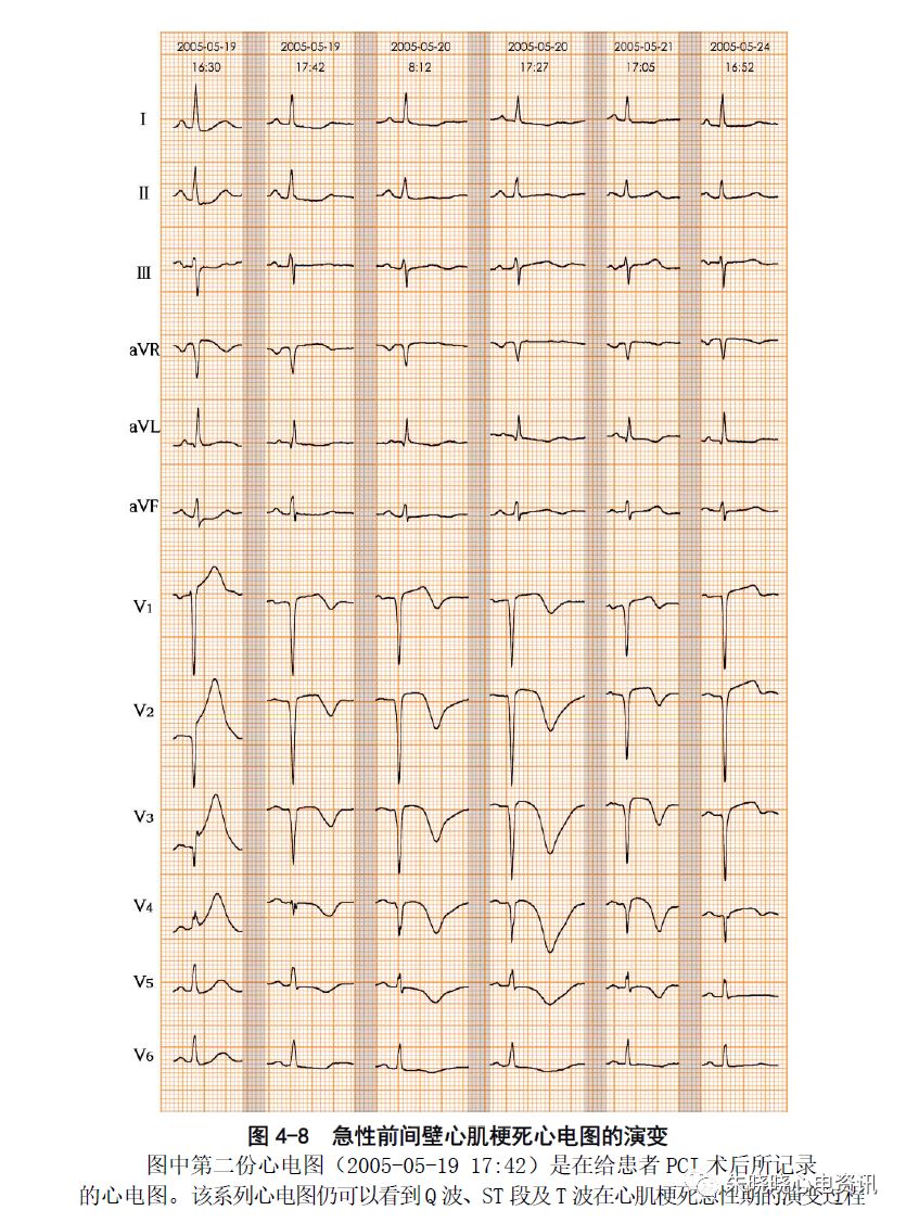 【张新民老师心电系列】第四讲:心电图对心肌梗死的诊断价值