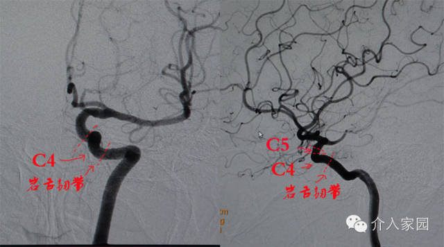 眼段(c6):该段起于远侧硬膜环,止于后交通动脉起点的紧近侧.