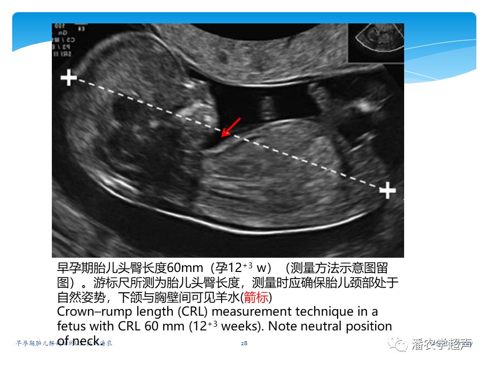 【超声微课堂】早孕期胎儿解剖结构超声检查及相关问题:头臀长,头部