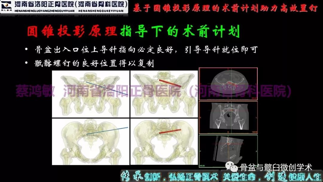 我们能精准置入骶髂螺钉comprehensiveppt讲义