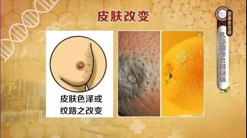 乳腺癌早期表现通常为乳房出现无痛,不容易被推动的肿块,如果发现有