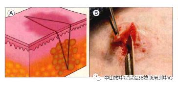 皮肤科临床技能培训之皮肤活检术