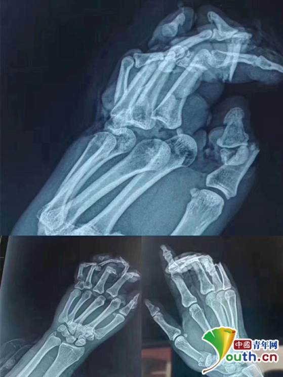伤者手部x光片,腕关节脱位,手掌离断,骨折,手指多节段离断.