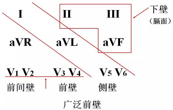 急性心肌梗死的定位诊断,可以"st段抬高"出现的导联为定位标准,示意