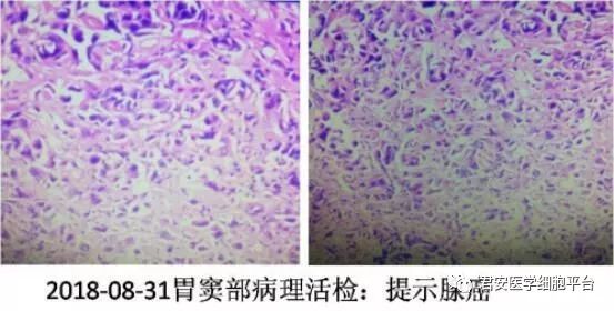 胃腺癌骨髓转移