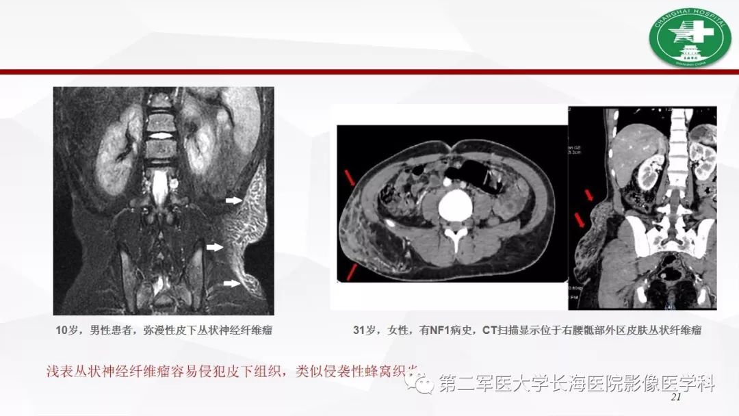 1型神经纤维瘤病及其相关肿瘤的影像表现