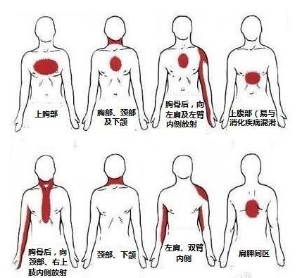 1,症状,不仅仅是疼,还可能是胸闷,憋气,心悸,心慌,出汗,先上厕所等等