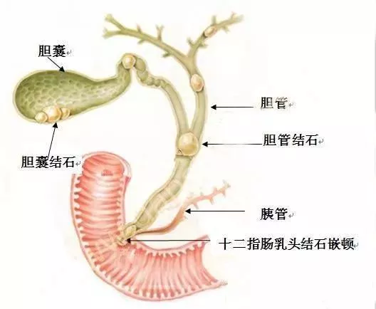 处的开口细如针尖,结石容易卡在胆总管下端,这样会导致胆汁反流到胰管