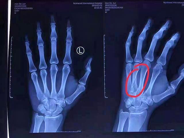 而就在刚刚网上爆出了关于韩德君的x光片,他的左手手掌部分有着明显的