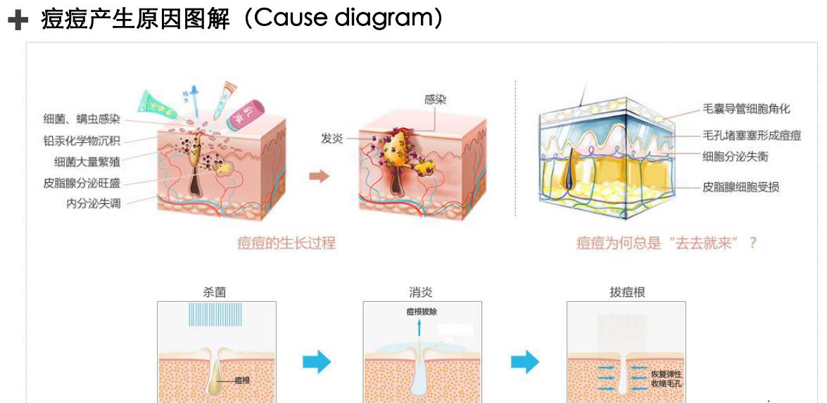 痤疮的形成原理示意图_痤疮形成阶段示意图