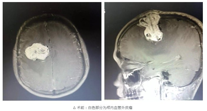 头痛两年,新晋奶爸竟然查出患有罕见脑肿瘤!_